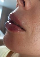 Ботулінотерапія ,збільшення губ... Объявления Bazarok.ua